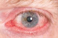 Beifuß Pollen Allergie Symptome Augen