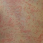 Arnika Allergie Hautausschlag