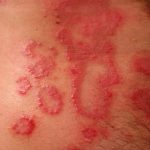 Heparin Allergie Hautausschlag