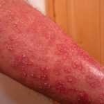 Nesselsucht juckender Hautausschlag am Arm