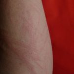 Hautallergie am Arm, Hautausschlag