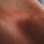 Hautallergie Ausschlag am Hals