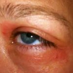 Auge Allergie Hautrötung
