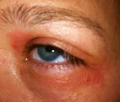 Augen Allergie Symptome Bilder Zu Allergischen Reaktionen Am Auge