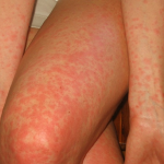 Allergie Symptome Ausschlag Arme und Beine