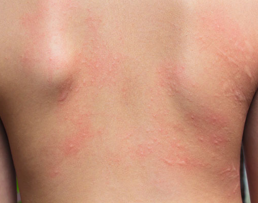 Hautallergie Symptome, Bilder allergischer Hautausschlag