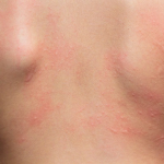 Allergie Symptome Ausschlag Rücken