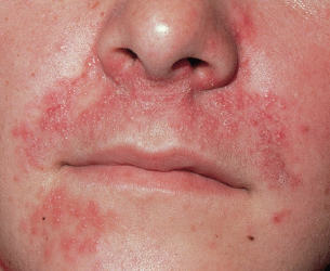 Erdbeerallergie Symptome Mit Bildern Und Tipps Fur Allergiker