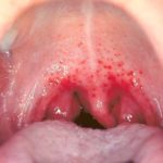 Erdbeerallergie Symptome Mund