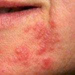 Allergischer Ausschlag, Bläschen im Gesicht