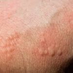 Flohbiss Allergie Symptome Arm