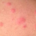 Flohbisse Allergie Symptome