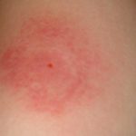 Mückenstichallergie Symptome Hautrötung