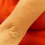 Mückenstichallergie Symptome Arm
