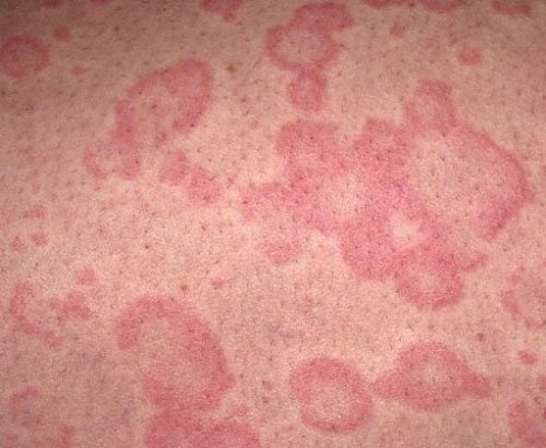 Nesselsucht Bilder: Symptome und Hautausschlag bei Nesselsucht