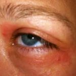 Hausstauballergie Hautausschlag Augen Gesicht