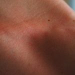Hausstauballergie Hautausschlag Kontaktallergie