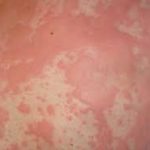 Hausstauballergie Hautausschlag Nesselsucht