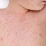 Waschmittelallergie Hautausschlag Brust, Nesselsucht