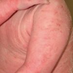 Allergischer Hautausschlag Neurodermitis Kind
