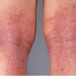Waschmittelallergie Hautausschlag, Neurodermitis, Beine