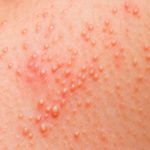 Bild: Allergie Symptom Bläschen auf der Haut