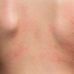 KatzenAllergie Symptome Haut