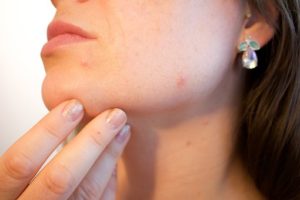 Pickel im Gesicht, Akne oder Allergie ?
